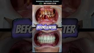 Full Mouth ImplantsAstonishing Result dentalimplants delhidentist [upl. by Ahsiugal]