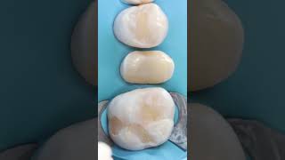 Restauración de premolar con endodoncia SIN POSTE NI CORONA Restauración Biomimética dentista [upl. by Leoine]