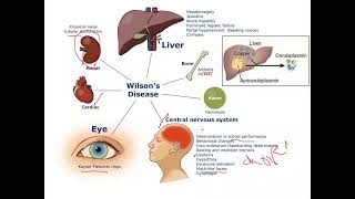 pediatric Hepatology Wilsons Disease [upl. by Procter813]