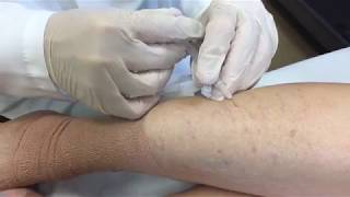 Varicose Vein Treatment  George Anton MD [upl. by Harp]