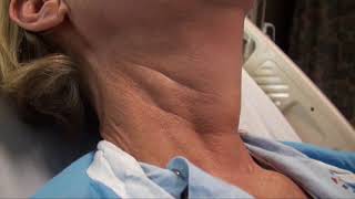 Regular Carotid Pulsation and Discernible Internal Jugular Venous Pulse [upl. by Suez]