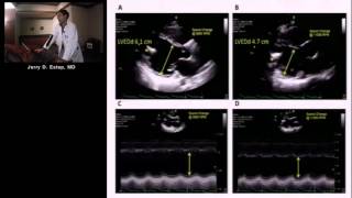 Imaging the Patient with Left Ventricular Assist Device Jerry Estep MDSu Min Chang MD [upl. by Stanislaw]