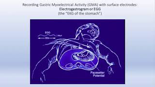 Gastroparesis Review and Update by Kenneth Koch MD [upl. by Alemahs700]