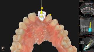 Carestream CS 9600 CBCT IOS Virtual Implant Planning [upl. by Ressler]