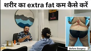 Liposuction In Surat  Liposuction Surgery Cost In Surat  Zenith Clinic [upl. by Friday]