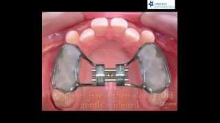 Palatal Expansion  RPE at Orleans Orthodontics [upl. by Safir]