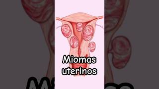 ¡Alerta Síntomas de Miomas uterinos  Dr William Guerrero medicina shorts [upl. by Delores]