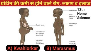 प्रोटीन की कमी से होने वाले रोग लक्षण व इलाज  Kwashiorkor disease  Marasmus disease [upl. by Bove936]