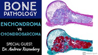 Chondrosarcoma vs Enchondroma Bone Pathology with Dr Andrew Rosenberg [upl. by Ayote]