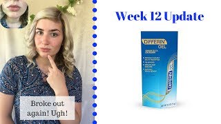 Differin Gel Retinoid Treatment  Week 12 Update [upl. by Rehpinnej]