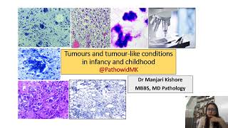 Tumor of infancy amp childhood [upl. by Fihsak]