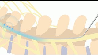 Animation of Spinal Cord Stimulator Implant Procedure [upl. by Gimble]