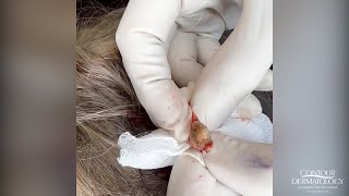 Extracting a Pilar Cyst Pilar Cysts Can Haunt Your Scalp  CONTOUR DERMATOLOGY [upl. by Ahtebat]