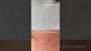 Microneedling smagliature [upl. by Peers]