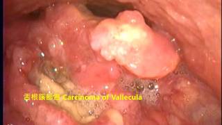 口咽癌、上喉癌、聲帶結節 Carcinomas of oropharynx vallecula amp larynx epiglottis vocal nodules [upl. by Calley]