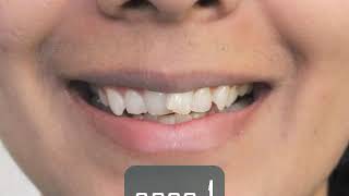 Overlapping teeth  Smile makeover by Dr Trivikram [upl. by Francesco448]