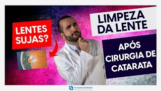 Capsulotomia com YAG laser limpeza da lente após cirurgia de catarata  Dr Gustavo Bonfadini [upl. by Lorimer]