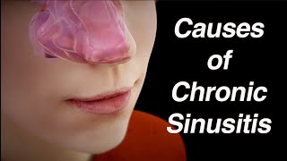 Causes of Chronic Sinusitis Anatomic Factors Biofilm Abnormal Microbiome [upl. by Acinat612]