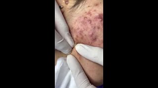 Best Pimple Popping 10 beautiful blackheads sacdepspa [upl. by Timmi]