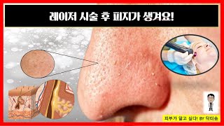 레이저 시술후 피지가 생겨요 레이저 시술후 생기는 피지 어떻게 해야 하나요 [upl. by Judson21]