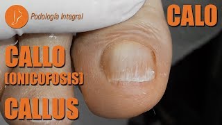 Callus on big toe Podología Integral podologiaintegral [upl. by Saucy659]