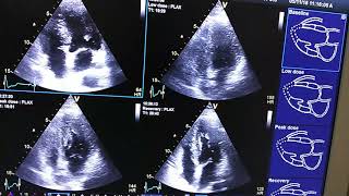 Digital Stress Echocardiography in LBBB [upl. by Ruff]