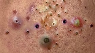 blackheads new 2023  popping pimple  acne and whiteheads removal [upl. by Barbaraanne684]