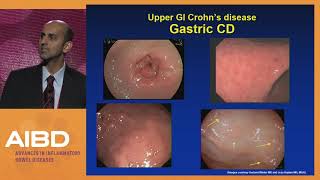 Diagnosing and treating Crohns disease of the esophagus stomach and duodenum [upl. by Nirmak]