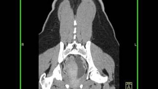 Abdomen Kidney Obstructed duplicated ureter Sagittal [upl. by Lerred]