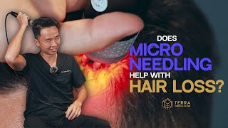 Is Microneedling The Cure For Hair Loss [upl. by Evoy]