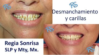 Desmanchamiento dental y carillas paciente con Flourosis [upl. by Ring]