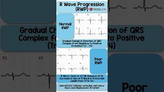 Normal vs Poor R Wave Progression RWP REBELEM ECG EKG RWaveProgression MedEd [upl. by Auqemahs590]