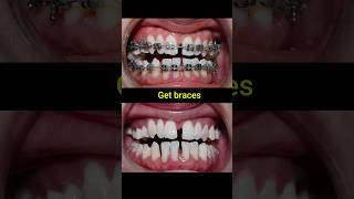 Braces evolution braces orthodontist dentist dental [upl. by Almap441]