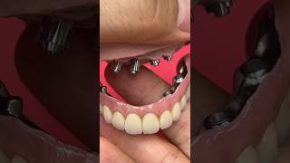 Creating Extraordinary Full Mouth Implants dentist dental shorts short shortvideo teeth metal [upl. by Oakleil]