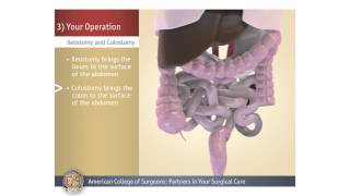 ColostomyIleostomy Your Operation [upl. by Ojyllek465]