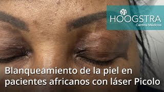 Blanqueamiento de la piel en pacientes africanos con láser Picolo 20212 [upl. by Barren]