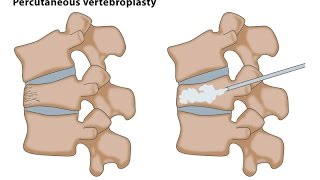 Percutaneous Vertebroplasty  Step wise demonstration of the technique [upl. by Llehsram]