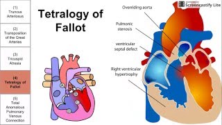 Cyanotic Congenital Heart Diseases [upl. by Anohsal770]