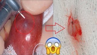 Home Remedies To Get Rid Of Mucocele Mucous Cyst For Good [upl. by Schaffel216]