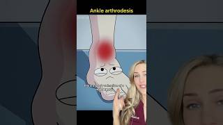 Doctor explains ankle fusion surgery [upl. by Kutzenco]