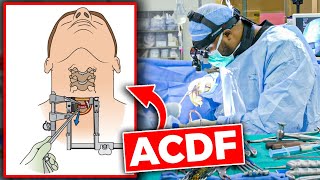 Anterior Cervical Discectomy and Fusion ACDF [upl. by Nielsen]