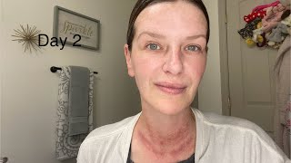 Day 2 after TCA chemical peel  TCA Peel  Chemical Peel [upl. by Gerianne927]