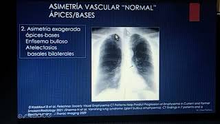 Parénquima pulmonar y cardiopatía cesar Pedroza [upl. by Idelia]