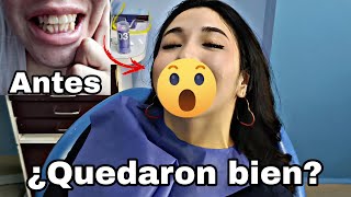 Me quitan los brackets después de 3 años en tratamiento  el resultado es increíble [upl. by Uzzi]