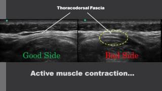 Thoracodorsal fascia ultrasound imaging [upl. by Anirok493]