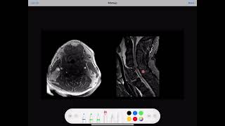 LEFT VERTEBRAL ARTERY DISSECTION [upl. by Cirri]