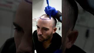 Before and After in Care4Hair  Hair Implant [upl. by Riordan]