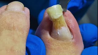 Podiatrist Reveals Simple Trick to Trim Long Thick Toenail [upl. by Eisse]