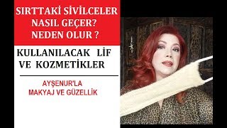 Sırtta Sivilce Neden Çıkar Nasıl Giderilir [upl. by Zebadiah]