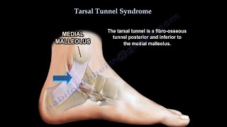 Tarsal Tunnel Syndrome causes and treatment [upl. by Ayouqat]